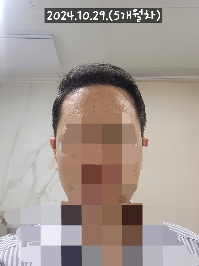 다나성형외과 무삭발/비절개/전두부위주/2300모낭/대량이식 5개월차 경과