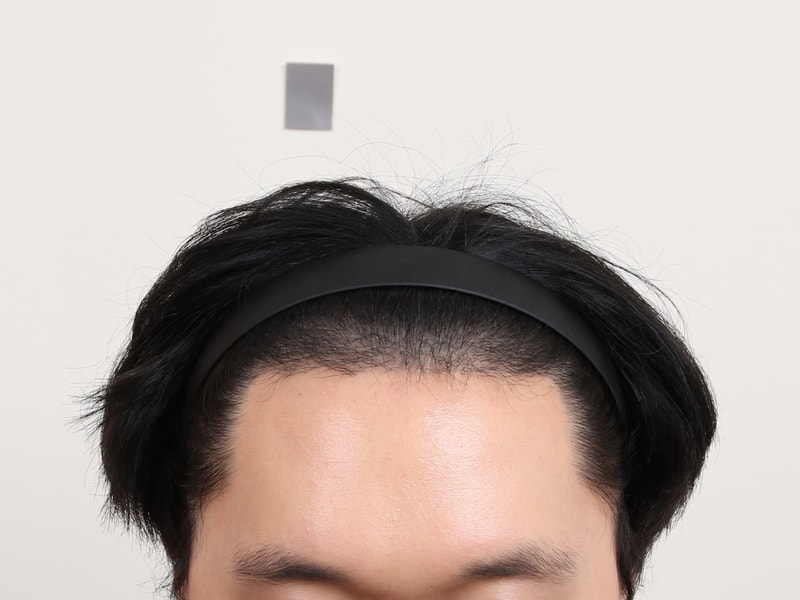 부산 맘모스 M자 모발이식 5개월 경과 후기