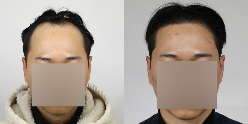 모우림 의원(강남 압구정) 4500모 M자 절개 모발이식 수술 1년 후