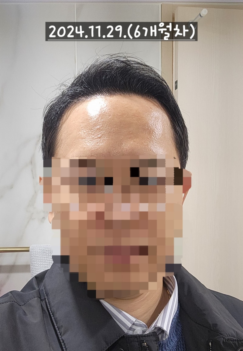 다나성형외과 무삭발/비절개/전두부위주/2300모낭/대량이식 6개월차 경과