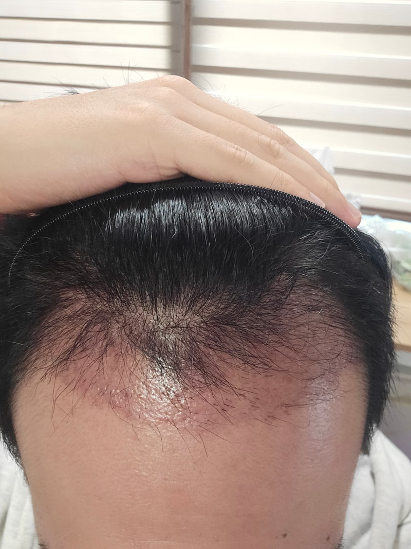 노블라인 이식 60일차입니다~(암흑기)