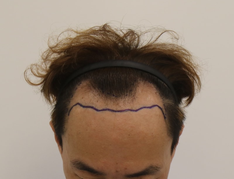 부산 맘모스 M자 모발이식 6개월 경과