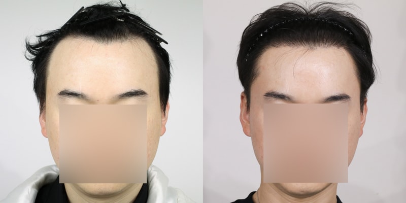 압구정역 모우림의원 비절개 모발이식 1년차 수술후기 입니다.(사진첨부)