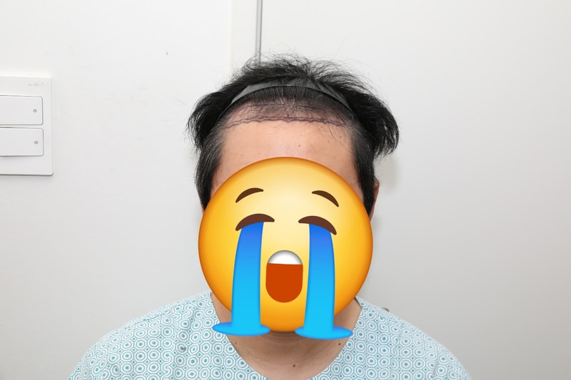 강남 뉴헤어에서 모발 이식 성공했습니다.