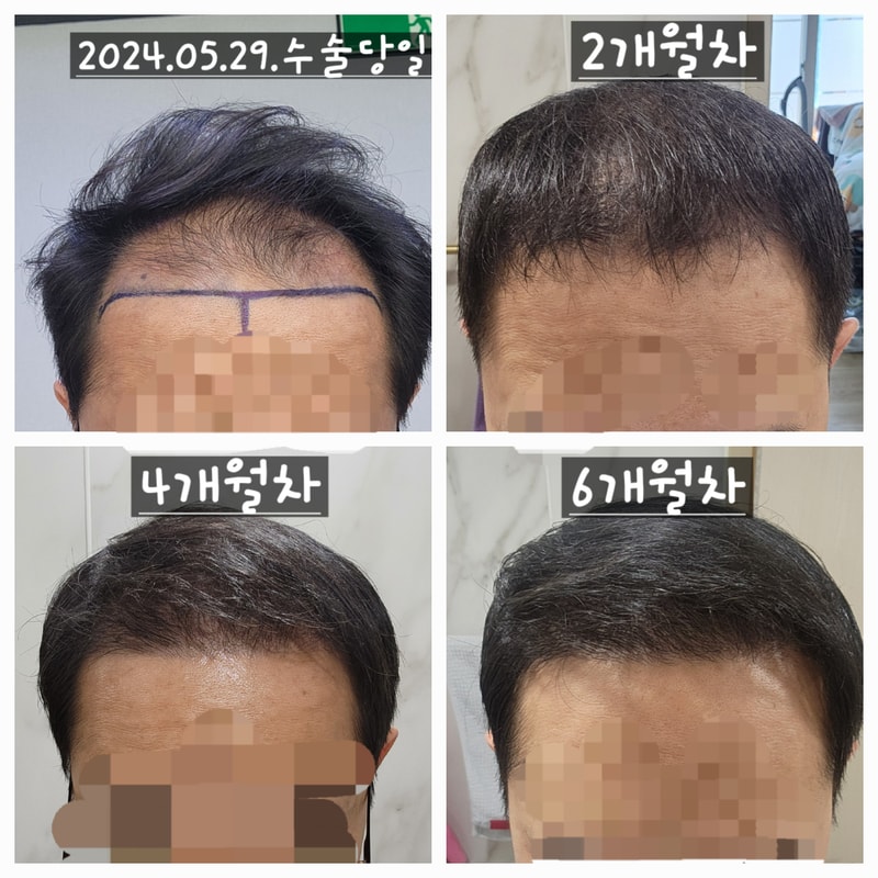 다나성형외과 무삭발/비절개/전두부위주/2300모낭/대량이식 8개월차 경과