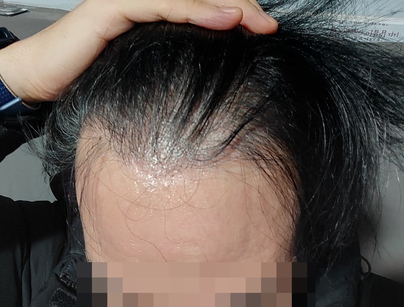 10년전 절개 오늘 비절개로 수술했습니다.