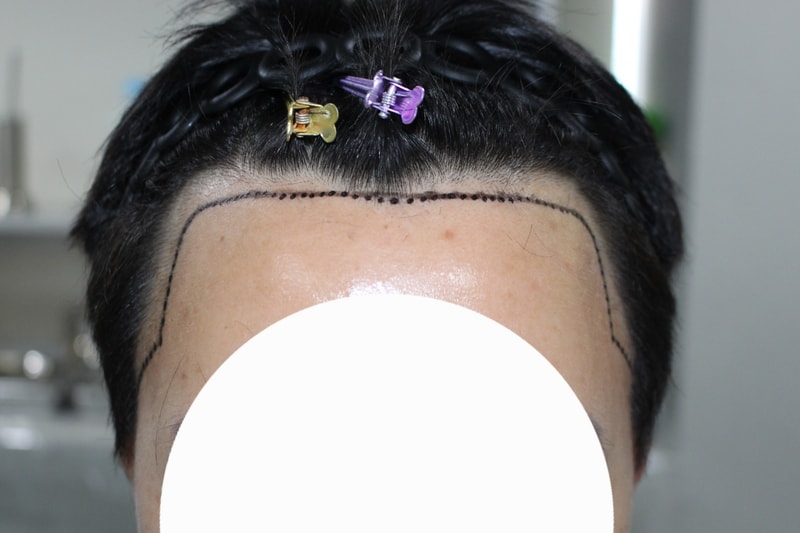 모다올 양유군 원장님께 모발이식 받은 후기입니다.
