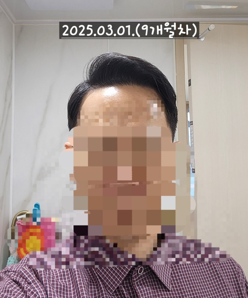 다나성형외과 무삭발/비절개/전두부위주/2300모낭/대량이식 9개월차 경과