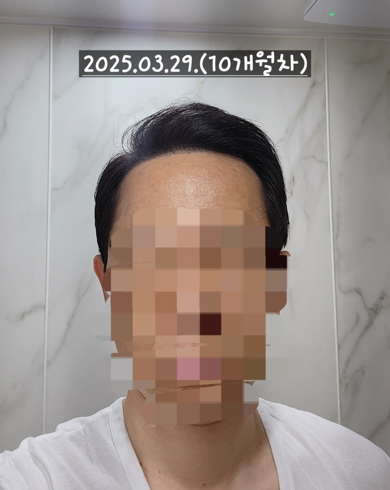다나성형외과 무삭발/비절개/전두부위주/2300모낭/대량이식 10개월차 경과