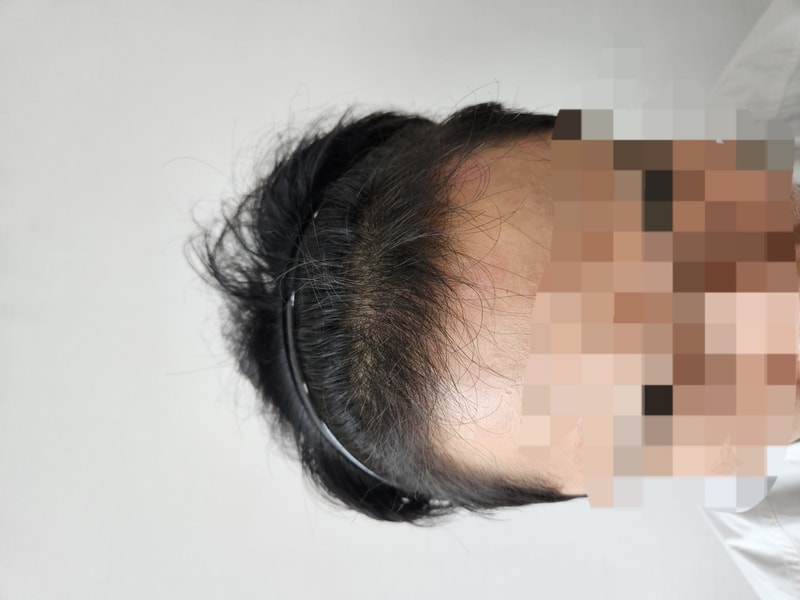 [After 4 months] M-shaped hair loss, 1,800 hair follicle non-cut surgery review