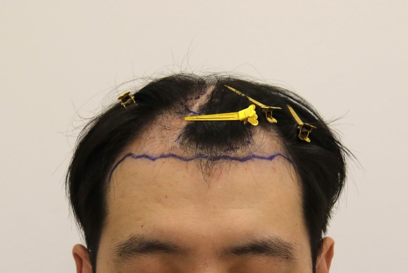 부산 맘모스 M자 모발이식 7개월 경과 후기