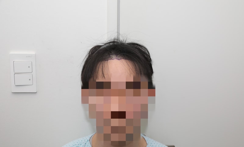 비절개 모발이식 1300모낭 밀도보강 1년차 후기