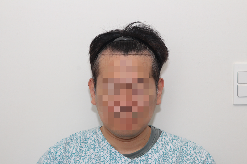 뉴헤어 모발이식 1600모낭 후기