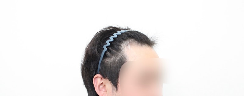 植毛2週目の体験談です。