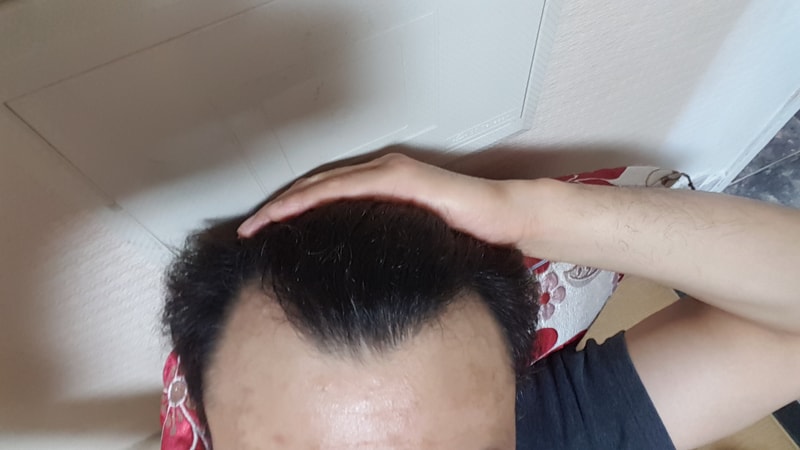 2차수술 비절개 정수리 1000모 후기입니다~