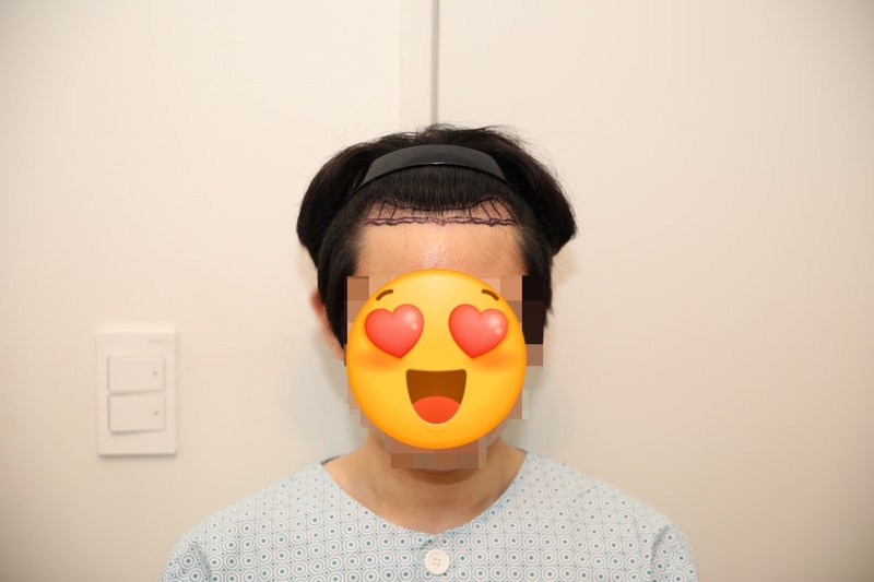 뉴헤어 4일차 비절개 모발이식 후기 입니다~ 1,300모낭 했어요