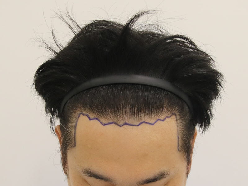 A year has passed since M-shaped hair transplant in Busan
