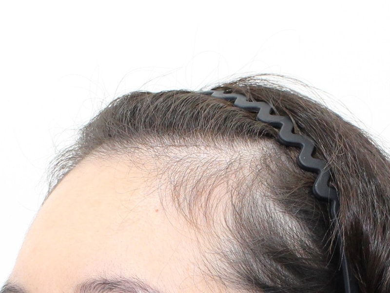 Shinja Station Mopro Clinic, Current Nurse ★, Hairline Correction, Day 10.