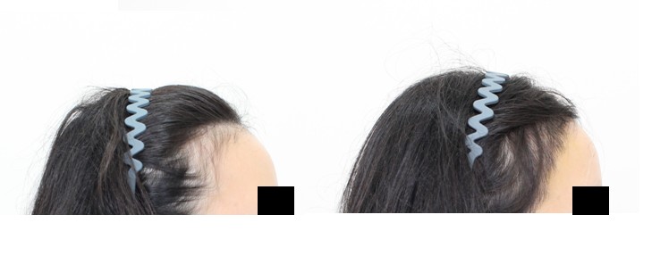신사역 모프로의원,헤어라인교정3688모, 현직 피부과의사 9일차