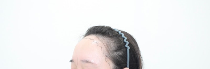 Hairline Hair Transplantation Day 10