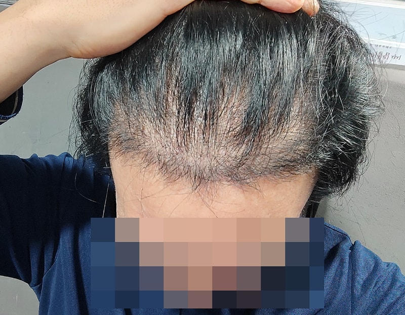 모발이식 비절개 3천모 4개월차 후기