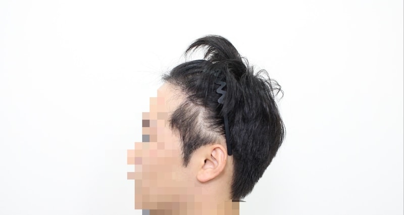 [경과체크] 신사역 모프로의원 문건학원장님 모발이식 비절개 6개월 경과