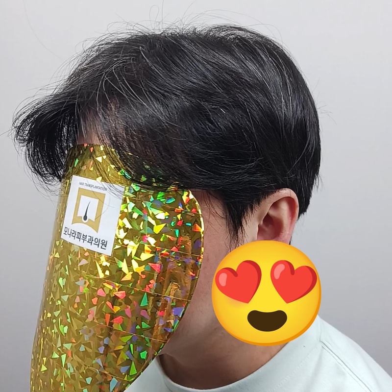 모나라피부과 1800모낭 비절개모발이식 12개월 경과