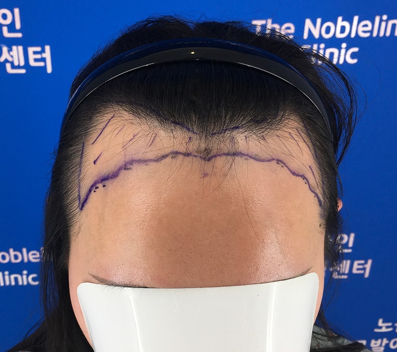 노블라인에서 헤어라인 채웠어요. 5개월 지났습니다.