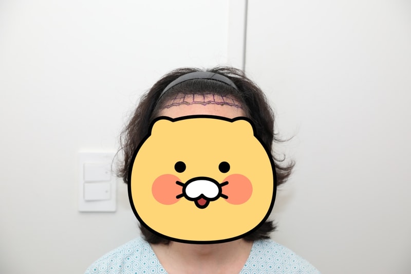 뉴헤어 7일차 비절개 모발이식 후기 (1500모낭)