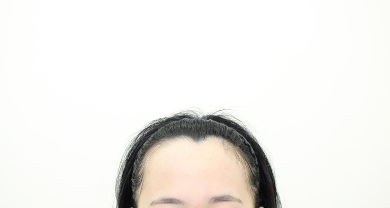Sinsa Station, Mopro Clinic ★ Director Moon Gun Academy, Hairline incision 3530mo, day 10