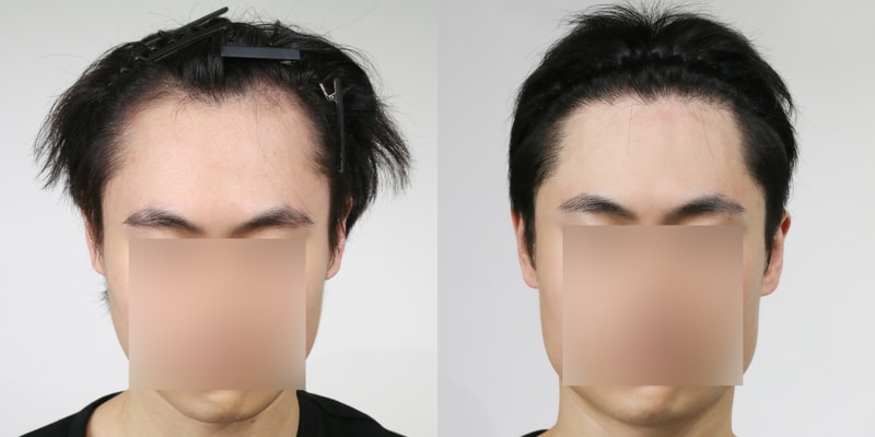압구정역 모발이식 모우림 의원 절개 3800모 1년차 후기
