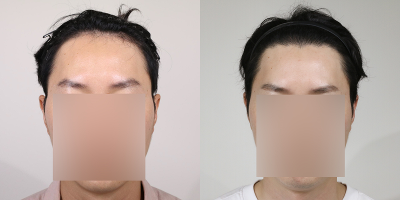 압구정 모우림의원 모발이식 2000천모 1년 경과(사진첨부)