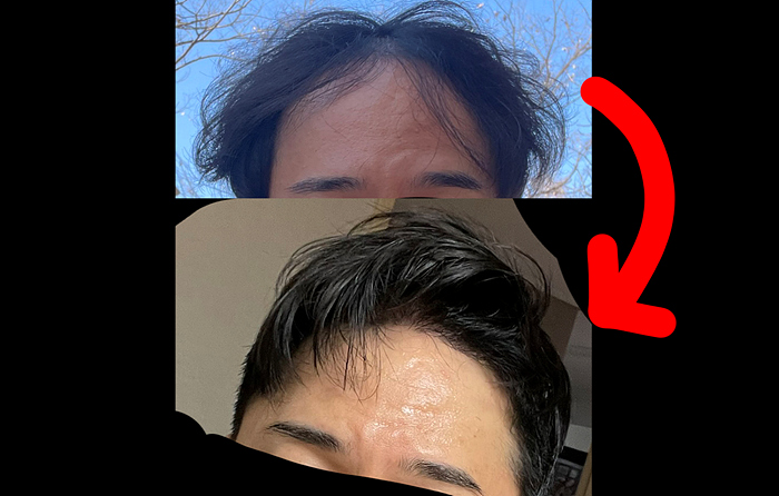 6개월 후기. 모발이식은 제 2의 인생입니다