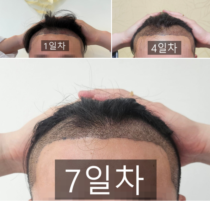 모재림 권남현 원장님께 받은 모발이식 7일차 후기입니다!!