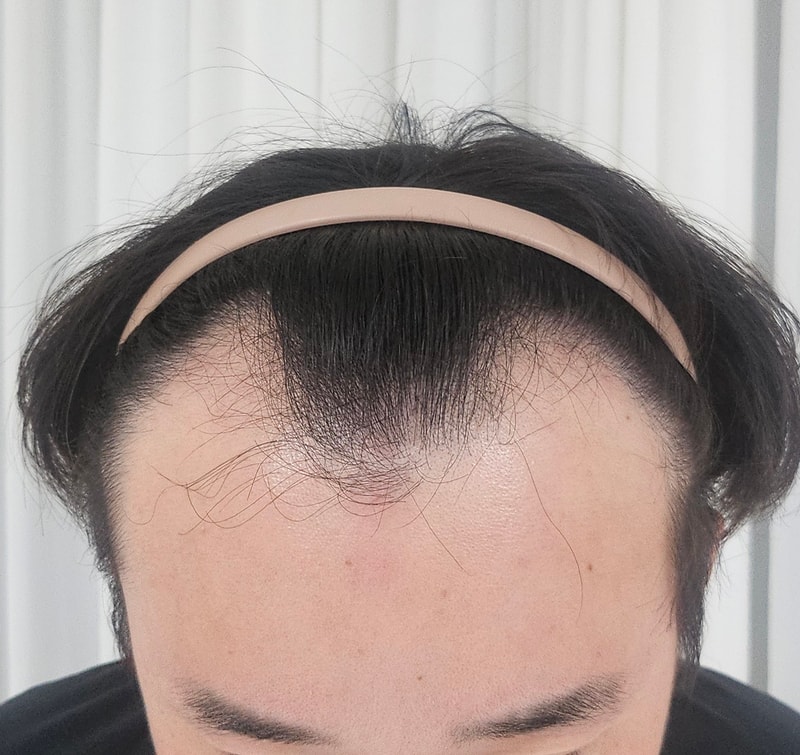 모재림 권남현 원장님께 받은 모발이식 1일차 후기입니다!!