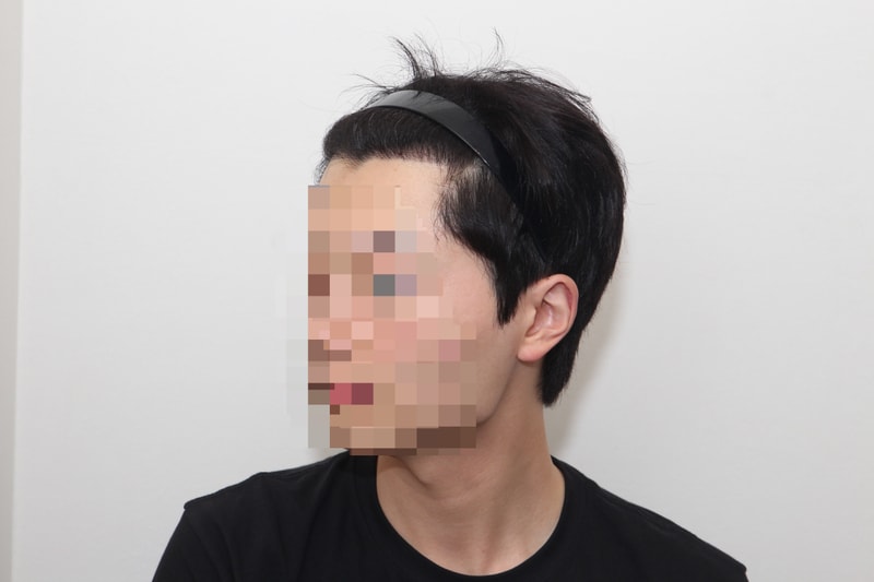 뉴헤어 서울점 비절개 모발이식 1300모낭(4000모) 6개월차 후기입니다