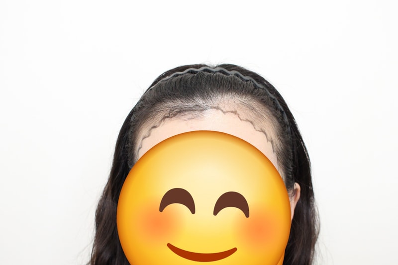 Women's hairline transplant in Sinsa-dong, Mopro Clinic, was reviewed after 11 days.
