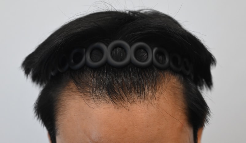 비절개 모발이식 수술 전 사진과 1년이 지난 후 사진을 공개합니다.