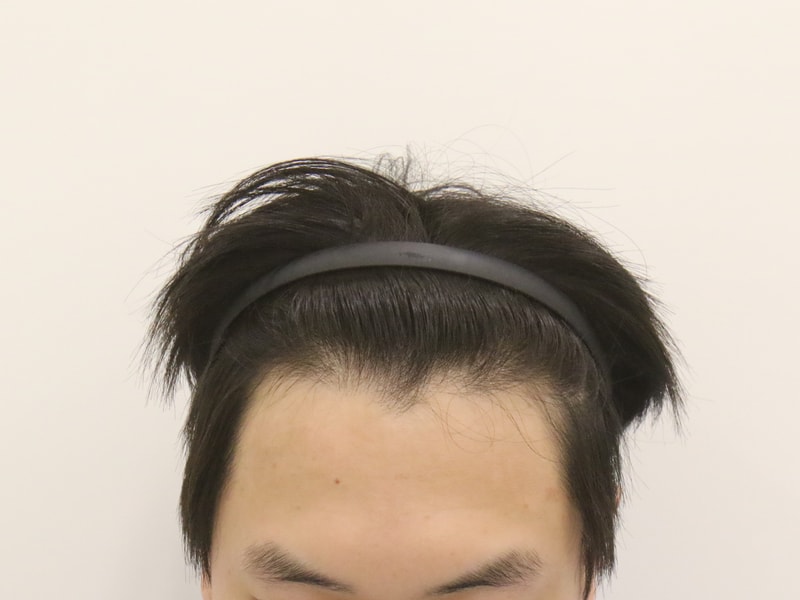 부산모발이식 슬릿방식 맘모스 M자 4개월 경과 후기
