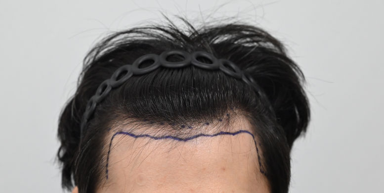 [MOEM Clinic] It's the 2nd week review of Hair Transplant's hidden cut.