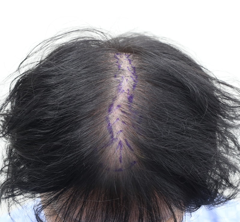狎鴎亭マンモスヘアラインクリニック拡散性薄毛頭頂部植毛 体験談