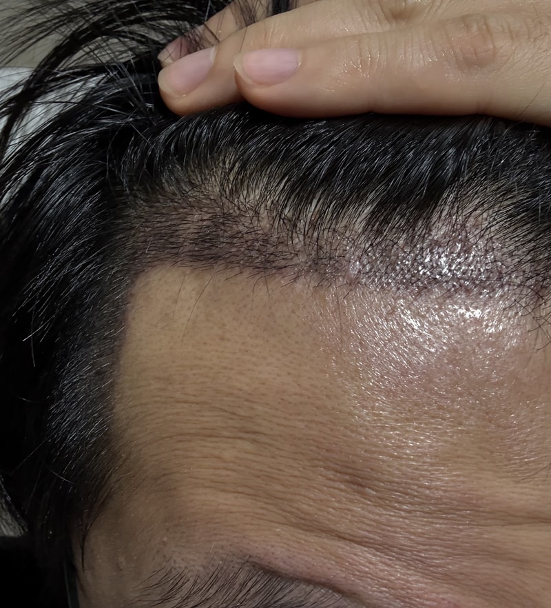 Top of the head 3000 Mo Hairline 2000 Mo Total 5000 Mo Nara Hair Transplant