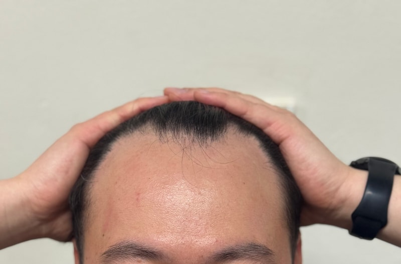 압구정 모우림의원 모발이식 1일차