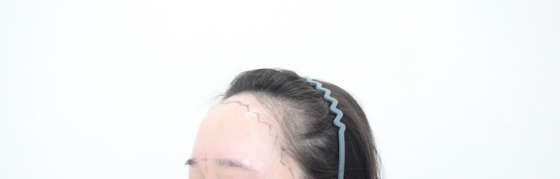 Hairline Hair Transplant incision in 6 months