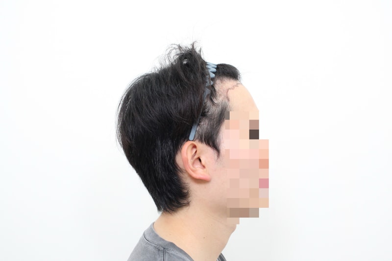 신사역 모프로의원, 카우릭 교정+ 모발이식 3700모 6개월 경과