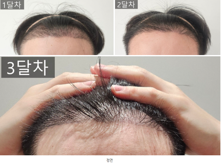 모제림 권남현 원장님께 받은 모발이식 3달차 후기입니다!!