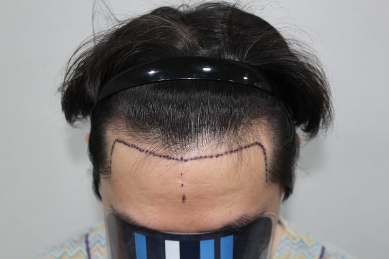 After the 16th day of the non-excisional Hair Transplant in the House of Moderna,