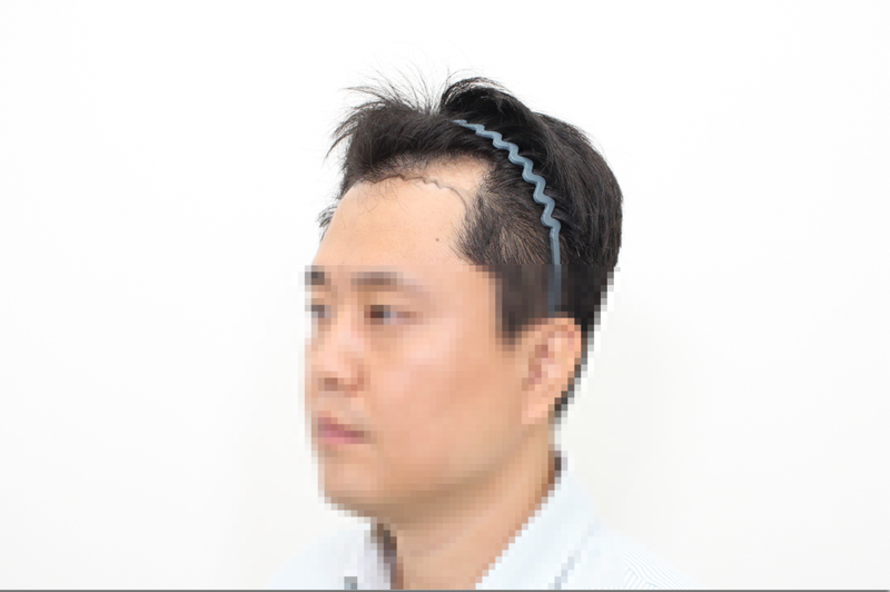 신사동 모프로의원, 모발이식 3600모 6개월 경과