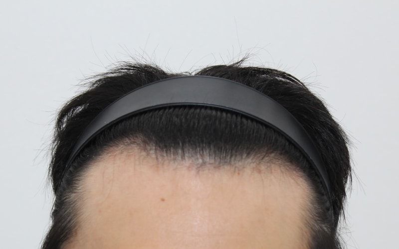 Post-mortem on the day of surgery for non-cutaneous Hair Transplant