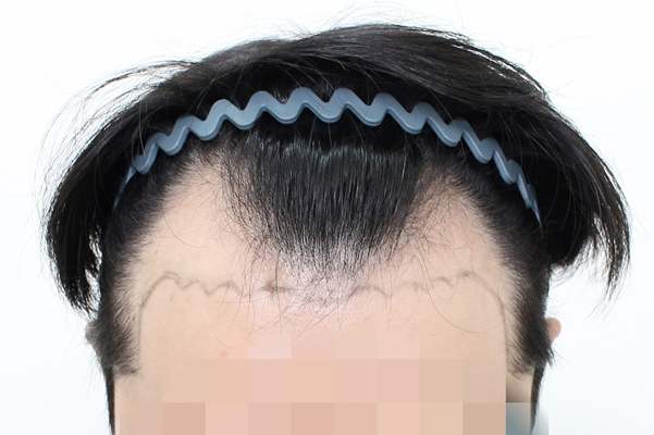 Sinsa-dong Mopro Clinic, Director of Mungeon Academy, 5500 non-cut Hair Transplant, about 6 months have passed